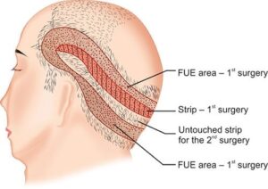 robotic hair transplant surgery